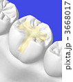 歯科治療 3668017