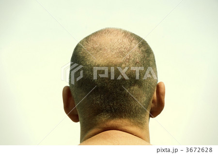 baldness baldness 3672628