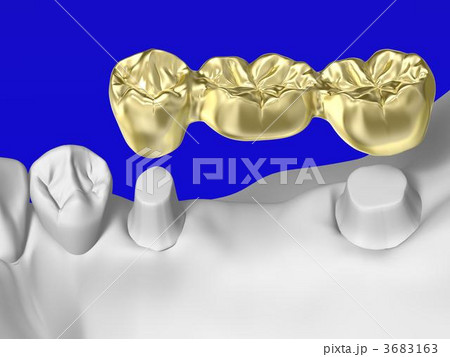 歯科治療 歯科治療 3683163