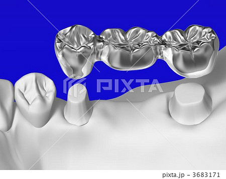 歯科治療 3683171