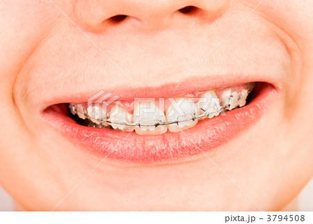 Braces 3794508