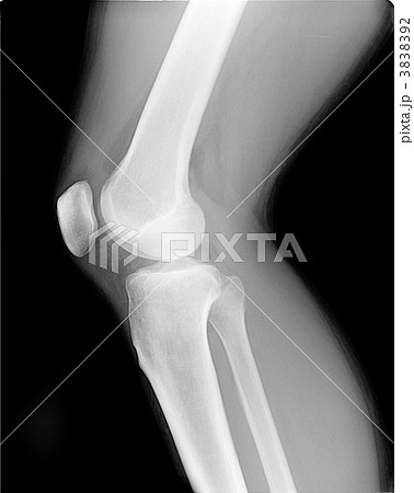 レントゲン 右膝関節とすね レントゲン 右膝関節とすね 3838392