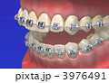 歯列矯正 3976491