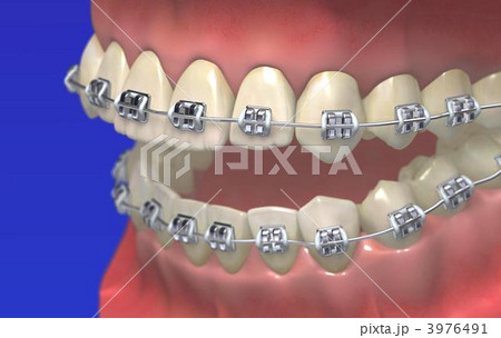 歯列矯正のイラスト素材 [3976491] PIXTA