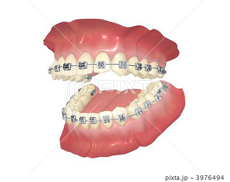 歯列矯正のイラスト素材