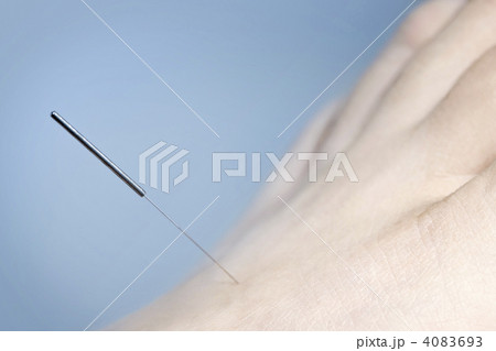 Acupuncture needle in foot Acupuncture needle in foot 4083693
