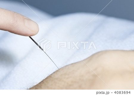 Acupuncture needle in skin 4083694
