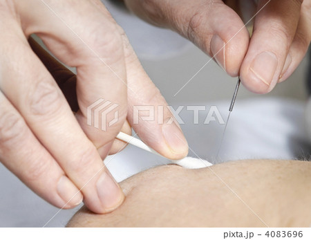 Acupuncture needle in skin 4083696