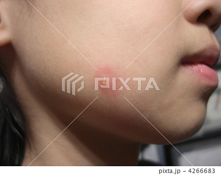 水ぶくれ 水泡 頬の写真素材 4266683 Pixta