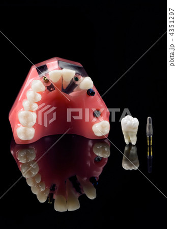 Real Human Wisdom tooth, Dental Implant and Plastic Teeth Model Real Human Wisdom tooth, Dental Implant and Plastic Teeth Model 4351297