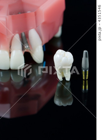 Real Human Wisdom tooth, Dental Implant and Plastic Teeth Model Real Human Wisdom tooth, Dental Implant and Plastic Teeth Model 4351546