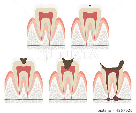 虫歯の進行の段階図のイラスト素材