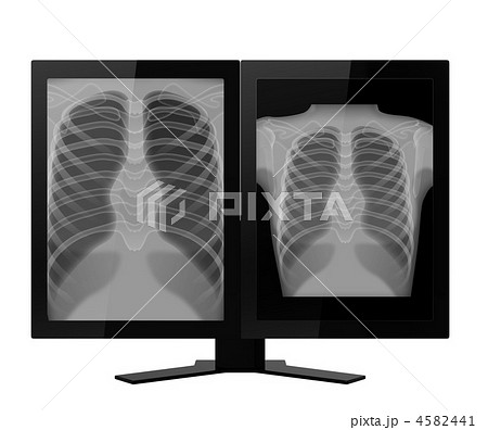 2画面モニターと胸部レントゲン画像 正面 のイラスト素材
