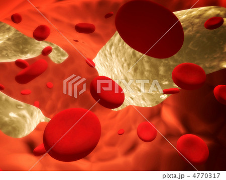 Atherosclerosis 4770317