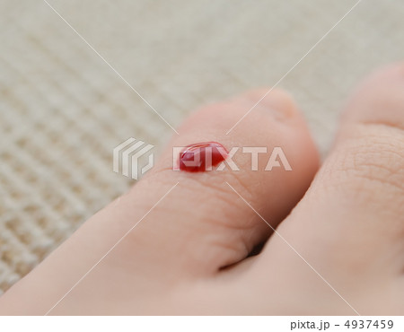小指のケガ 4937459