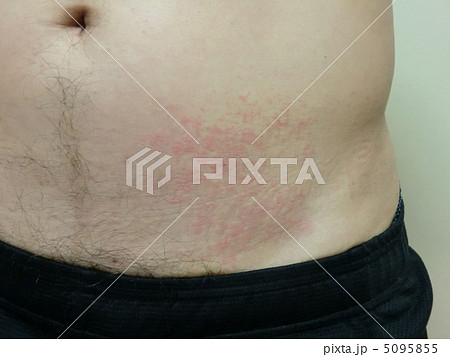 じんましんによる皮膚炎 5095855