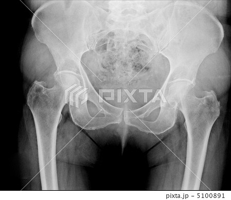 X-ray of the pelvis 5100891