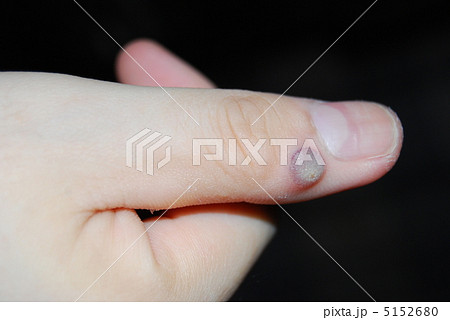 治療中の男性の疣 5152680