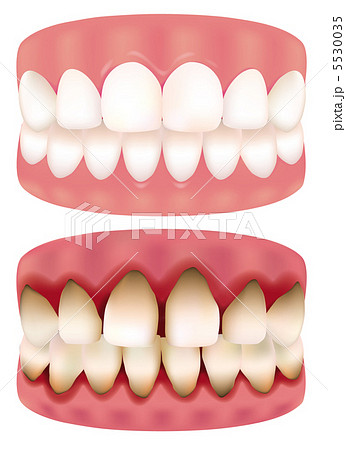 歯周病のイラスト素材