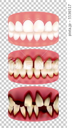 歯周病進行度 5536517