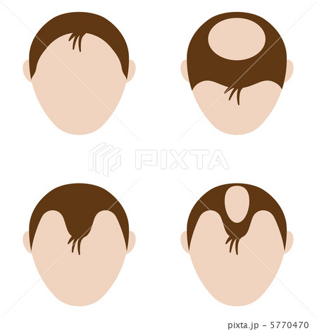 脱毛-9 脱毛-9 5770470