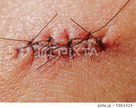 縫合された傷口 縫合された傷口 5963424