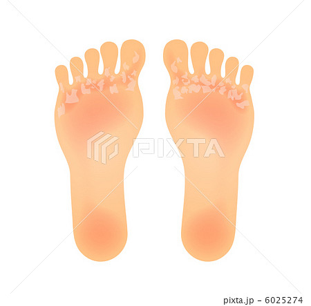 皮がむける足裏のイラスト素材