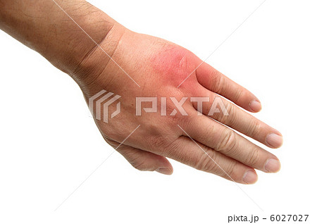 虫に刺されて腫れ上がった男性の手 虫に刺されて腫れ上がった男性の手 6027027