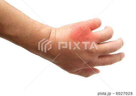 虫さされ 虫さされ 6027028