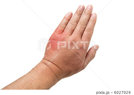 虫さされ 6027029