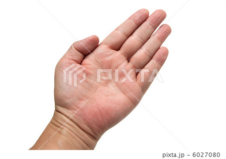 down syndrome hand characteristics
