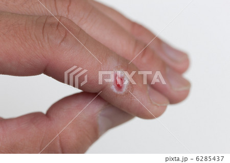 治りかかかった切り傷 治りかかかった切り傷 6285437
