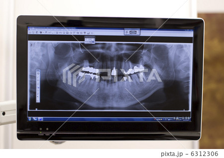 歯のレントゲン画像　デンタルイメージ 6312306