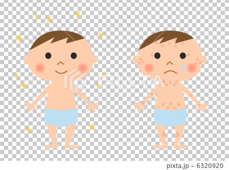 子供とアトピー 6320920