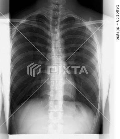 レントゲン写真　X線写真　　Z97 レントゲン 胸椎の写真素材 [6510991] - PIXTA