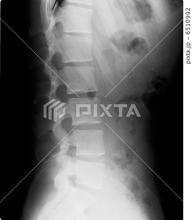レントゲン 腰椎 レントゲン 腰椎 6510992