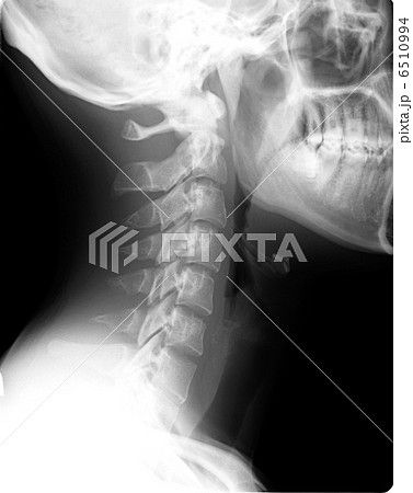 レントゲン 頸椎 レントゲン 頸椎 6510994