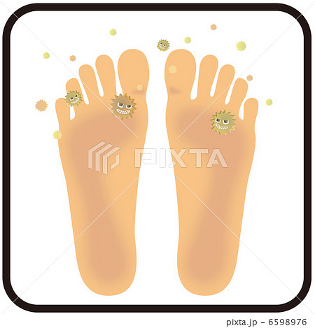 水虫(足の裏）A-4 6598976