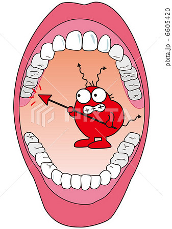 口の中と虫歯菌のイラスト素材