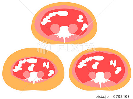 内臓脂肪と皮下脂肪の断面図 6702403