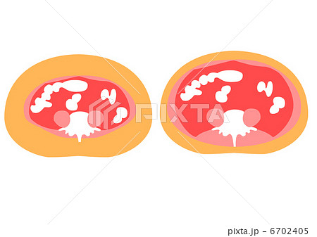 内臓脂肪と皮下脂肪の断面図のイラスト素材