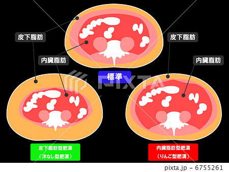 内臓脂肪と皮下脂肪の断面図 6755261