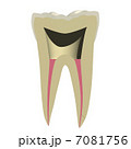 根充した歯 7081756