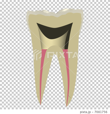 Tooth rooted 7081756
