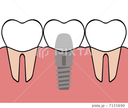 デンタルインプラント 7155690