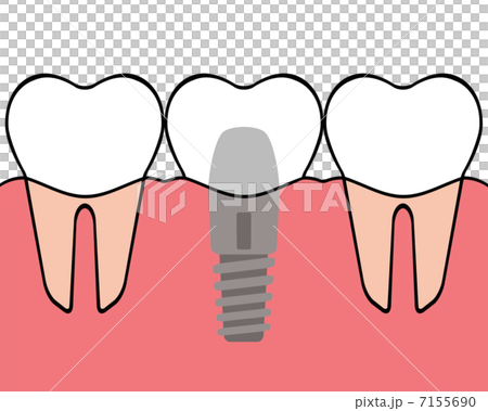デンタルインプラント 7155690