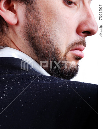 Dandruff issue on mans sholder Dandruff issue on mans sholder 7391507