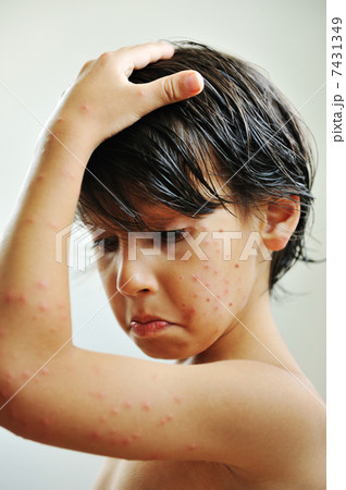 Skin illness 7431349
