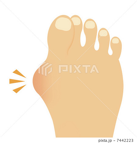 外反母趾 7442223