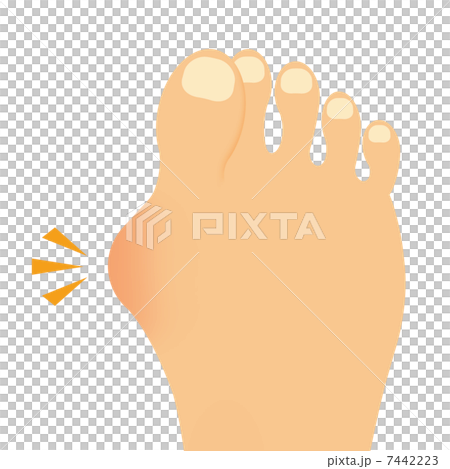 外反母趾 7442223